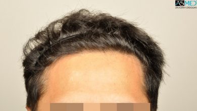 dr-erdogan-hair-transplant-result (2)