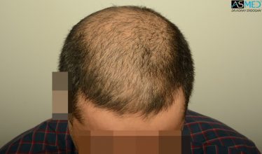 dr-erdogan-hair-transplant-result (3)