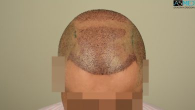 dr-erdogan-hair-transplant-result (4)