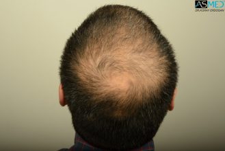 dr-erdogan-hair-transplant-result (5)