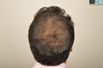dr-erdogan-hair-transplant-result (6)