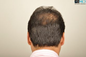dr-erdogan-hair-transplant-result (7)