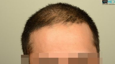 dr-erdogan-hair-transplant-result (8)