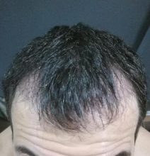dr-kul-hair-transplant (10)