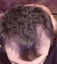 dr-kul-hair-transplant (11)