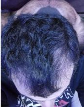 dr-kul-hair-transplant (12)