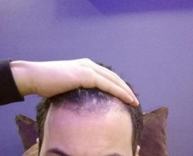 dr-kul-hair-transplant (13)