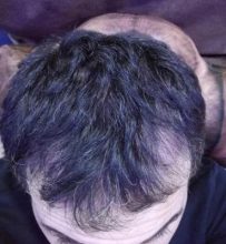 dr-kul-hair-transplant (14)