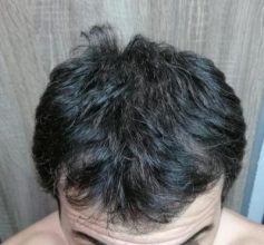 dr-kul-hair-transplant (15)