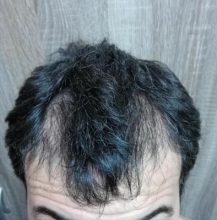 dr-kul-hair-transplant (18)