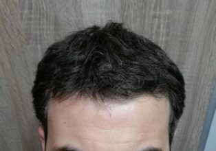 dr-kul-hair-transplant (19)