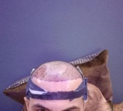 dr-kul-hair-transplant (2)