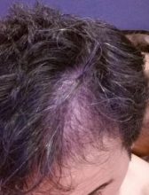 dr-kul-hair-transplant (20)