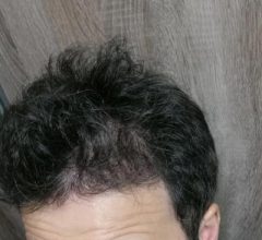 dr-kul-hair-transplant (21)