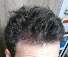 dr-kul-hair-transplant (22)