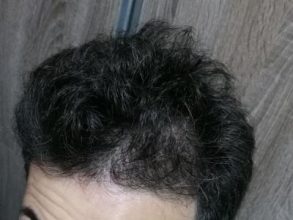 dr-kul-hair-transplant (23)