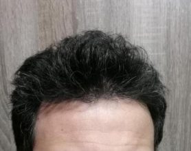 dr-kul-hair-transplant (24)