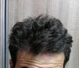 dr-kul-hair-transplant (25)