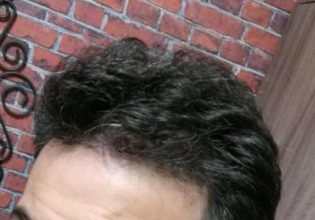 dr-kul-hair-transplant (26)