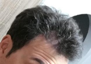 dr-kul-hair-transplant (27)