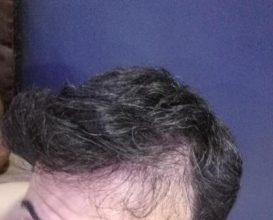 dr-kul-hair-transplant (28)
