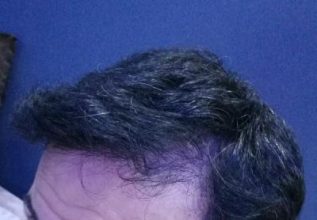 dr-kul-hair-transplant (29)