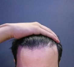 dr-kul-hair-transplant (31)