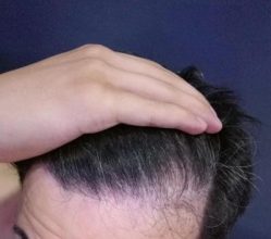 dr-kul-hair-transplant (32)