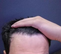 dr-kul-hair-transplant (33)