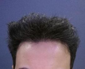dr-kul-hair-transplant (34)