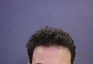 dr-kul-hair-transplant (35)