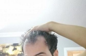 dr-kul-hair-transplant (36)