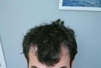 dr-kul-hair-transplant (37)