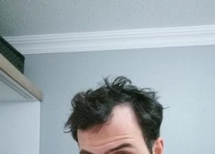 dr-kul-hair-transplant (38)