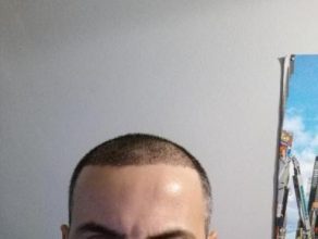 dr-kul-hair-transplant (4)