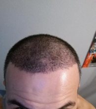 dr-kul-hair-transplant (5)