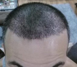 dr-kul-hair-transplant (6)