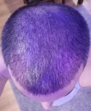 dr-kul-hair-transplant (7)