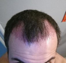 dr-kul-hair-transplant (8)