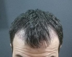 dr-kul-hair-transplant (9)