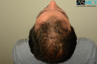 fue-hair-transplant (1)