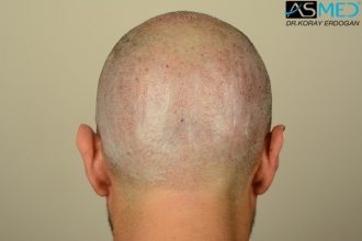 fue-hair-transplant (10)