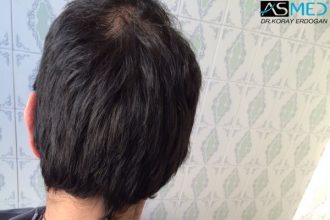 fue-hair-transplant (11)