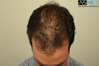 fue-hair-transplant (15)