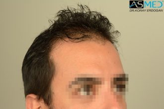 fue-hair-transplant (16)