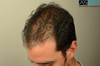 fue-hair-transplant (17)