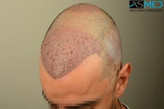 fue-hair-transplant (3)