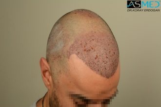 fue-hair-transplant (4)