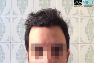 fue-hair-transplant (6)