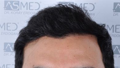 fue-hair-transplant (7)